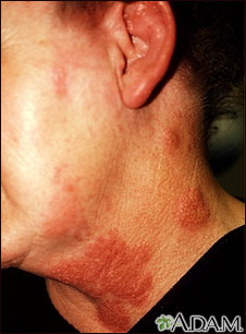 Herpes zoster (shingles) on the neck and cheek