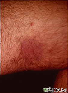 Kaposi's sarcoma on the thigh