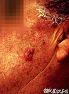 Squamous cell carcinoma - invasive