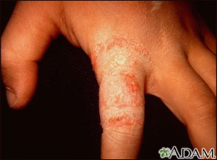 Ringworm, tinea manuum on the finger