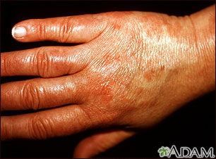 Vasculitis, urticarial on the hand