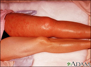 Deep venous thrombosis, ileofemoral