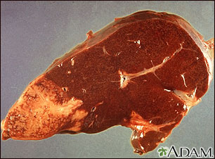 Hodgkin's disease, liver involvement