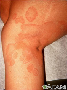 Ringworm, tinea corporis on the leg