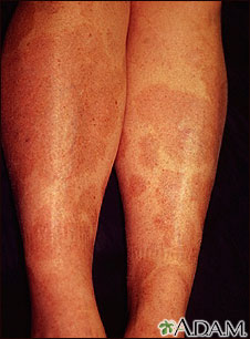 Granuloma, annulare on the legs