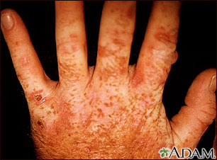 Porphyria cutanea tarda on the hands