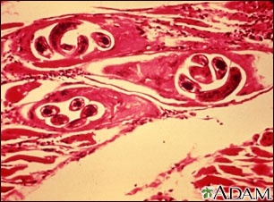 Trichinella spiralis in human muscle