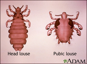 Head louse and pubic louse