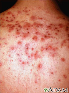 Acne, close-up of cysts on the back