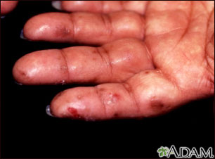 Dermatitis, herpetiformis on the hand