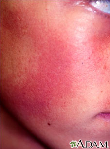 Keratosis pilaris rubra faceii