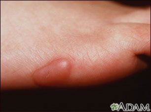 Keloid, on the foot