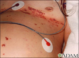 Herpes zoster (shingles), disseminated