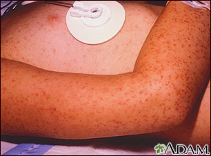 Rocky mountain spotted fever, petechial rash