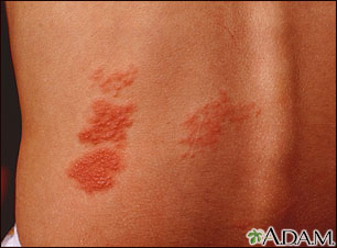 Herpes zoster (shingles) on the back