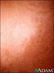 Hyperpigmentation 2