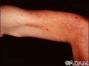 Telangiectasias - upper arm