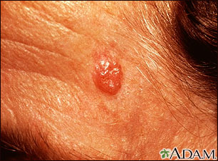 Basal Cell Carcinoma - face