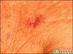 Basal Cell Carcinoma - close-up