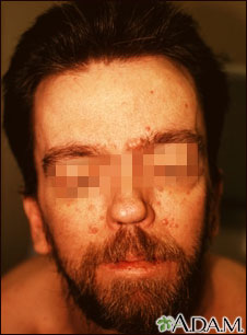 Basal cell nevus syndrome - face