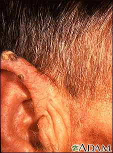 Actinic keratosis - ear