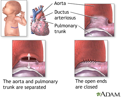 Procedure