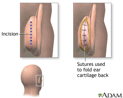 Procedure