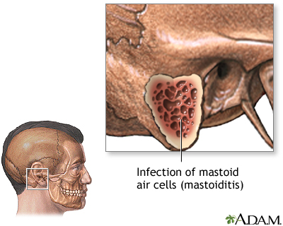 Mastoiditis