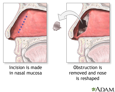 Procedure