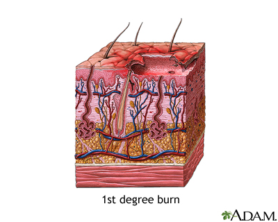 First degree burn