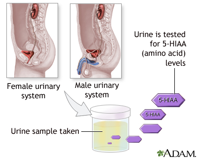 Aminoaciduria urine test