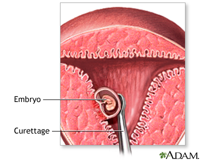 Abortion procedure