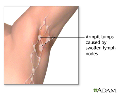 Swollen lymph nodes under arm