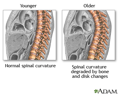 Changes in spine with age