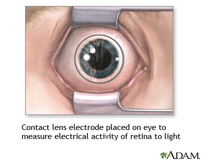 Contact lens electrode on eye