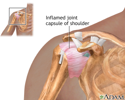 Shoulder joint inflammation