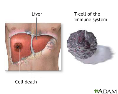 Liver cell death