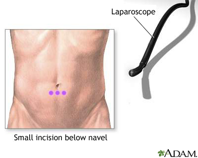 Incision for abdominal laparoscopy