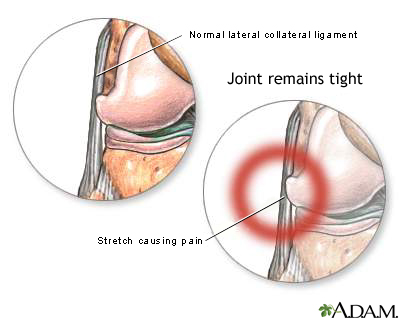 Lateral collateral ligament pain