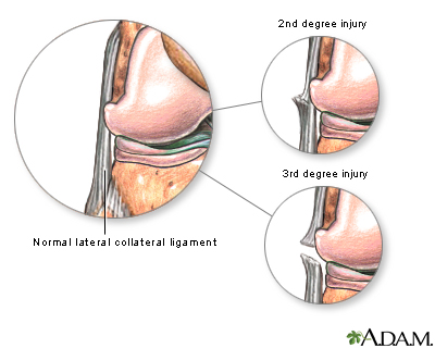 Lateral collateral ligament injury