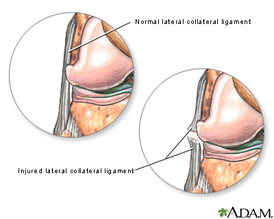 Torn lateral collateral ligament