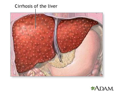  Cirrhosis of the liver