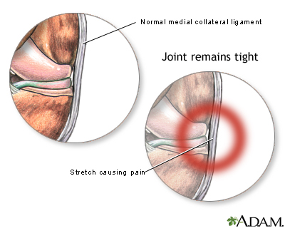 Medial collateral ligament pain