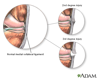 Medial collateral ligament injury