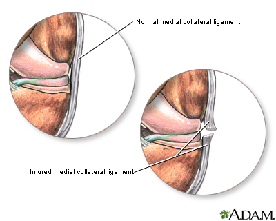 Torn medial collateral ligament