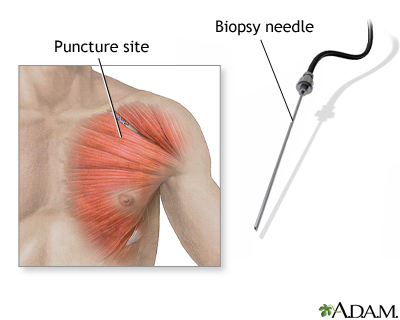 Muscle biopsy