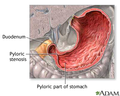 Pyloric stenosis