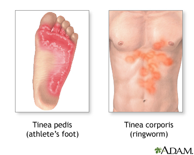 Tinea (ringworm)