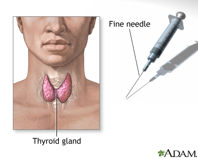 Thyroid gland biopsy