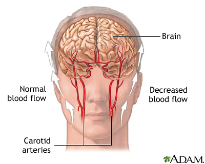 Transient Ischemic attack (TIA)